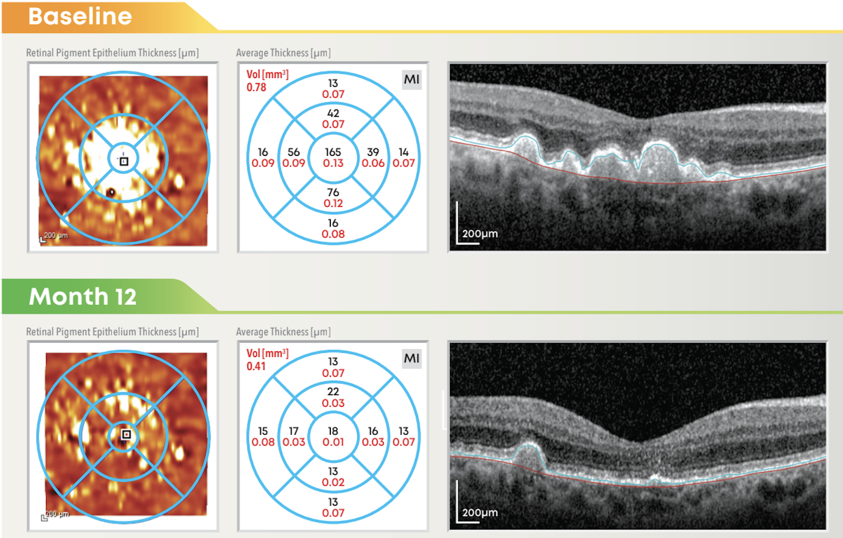 Expected Results of AMD Treatment